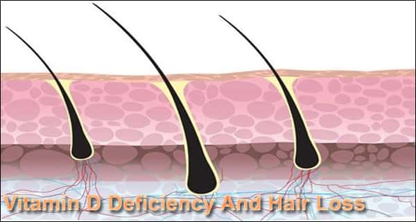 Vitamin D Deficiency And Hair Loss