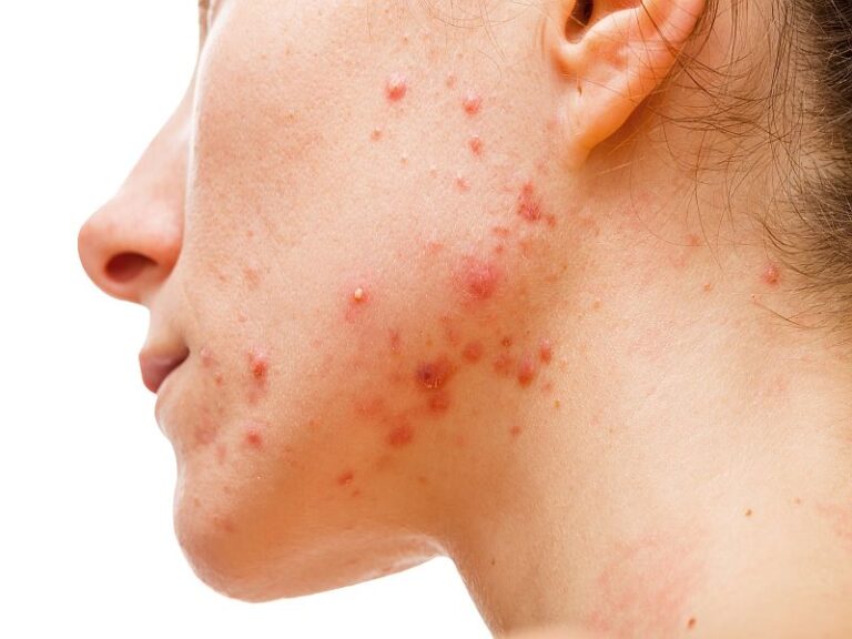 How to treat Depression Acne?